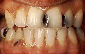 Manchas e Escurecimentos Dentais e Aumento da Espessura da Dentina