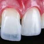 Odontologia Estética Zona Sul de SP, Lentes de Contato Dentais Zona Sul SP,