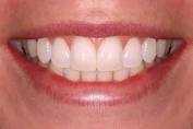 Invisalign Zona Sul SP - Odontologia Apeles Lemos - 5563-5471