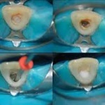 Odontologia Estética Zona Sul de SP, Clareamento Dental Interno Zona Sul SP. Odontologia Estética Zona Sul de SP, Clareamento Dental Interno Zona Sul SP.