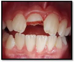 FRATURA DENTAL