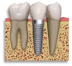 Implantes Dentais Implantes Dentais