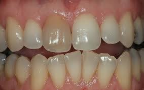 Escurecimento Dental Escurecimento Dental