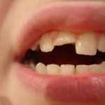 Fratura Dental Zona Sul, Fratura Dental Zona Sul SP, Fratura Dental na Zona Sul, Fratura Dental na Zona Sul SP