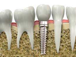 Implantes Dentários Implantes Dentários