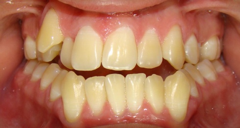 má oclusão dentária