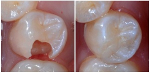 Restaurações Dentárias Estéticas em Resina, Restaurações Dentárias Estéticas em Resina Zona Sul, Restaurações Dentárias Estéticas em Resina Zona Sul SP, Restaurações Dentárias Estéticas em Resina, Restaurações Dentárias Estéticas em Resina Zona Sul, Restaurações Dentárias Estéticas em Resina Zona Sul SP,