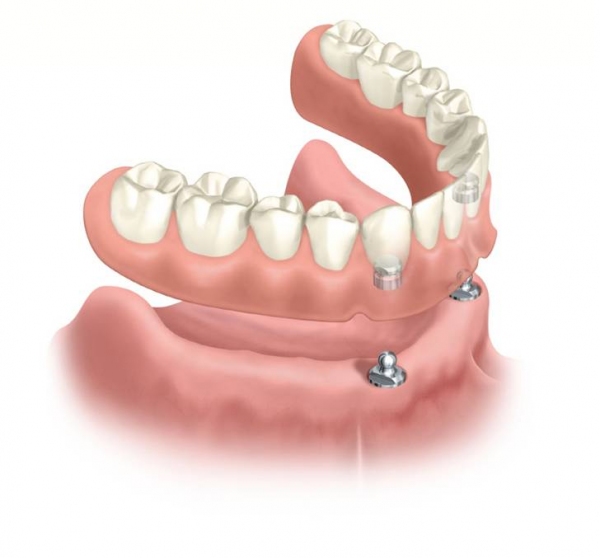 Overdentures Zona Sul SP - Odontologia Apeles Lemos - 5563-5471