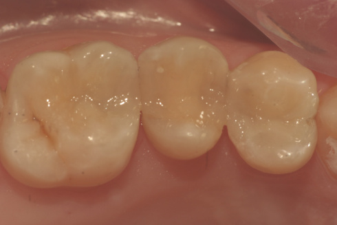 RESTAURAÇÕES ESTÉTICAS EM RESINA COMPOSTA