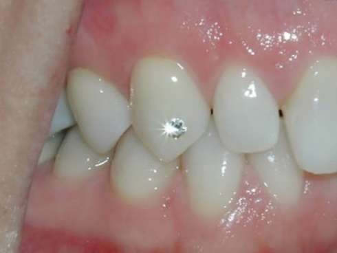PIERCING DENTAL