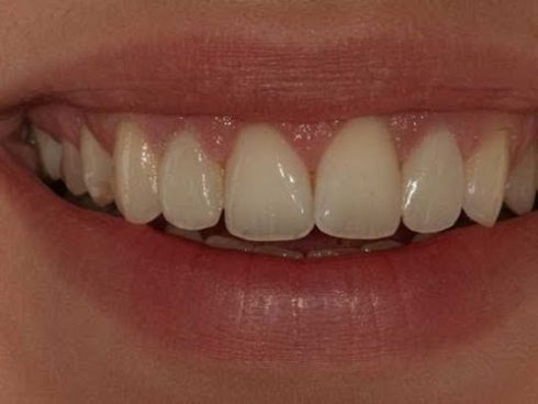 FACETAS DENTÁRIAS DIRETAS EM RESINA COMPOSTA