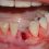 Cuidados Após Extração Dental