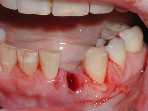 Cuidados Após Extração Dentária
