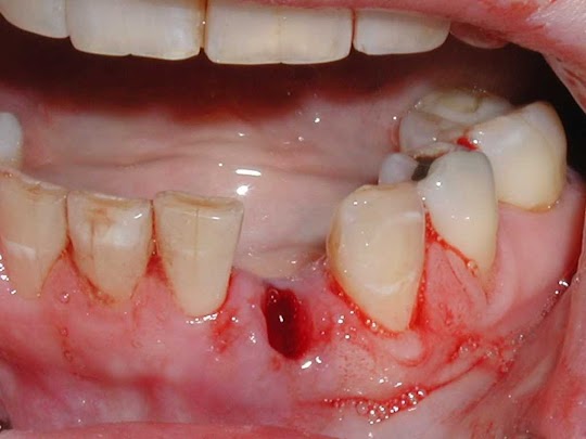 Cuidados Após Extração Dentária Cuidados Após Extração Dentária