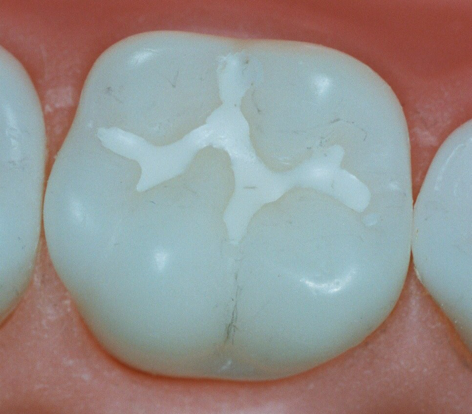 Selantes Dentários Selantes Dentários