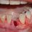 Cuidados Pós-Extração Dentária