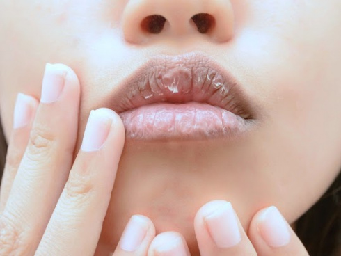 Xerostomia ou Boca Seca