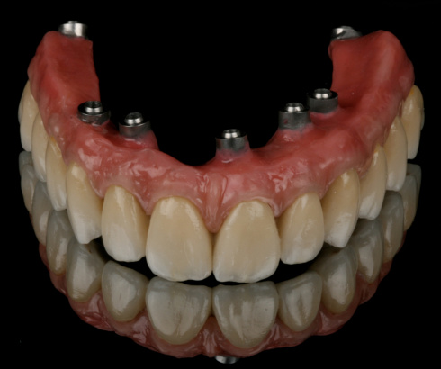 PRÓTESE PROTOCOLO DE IMPLANTES