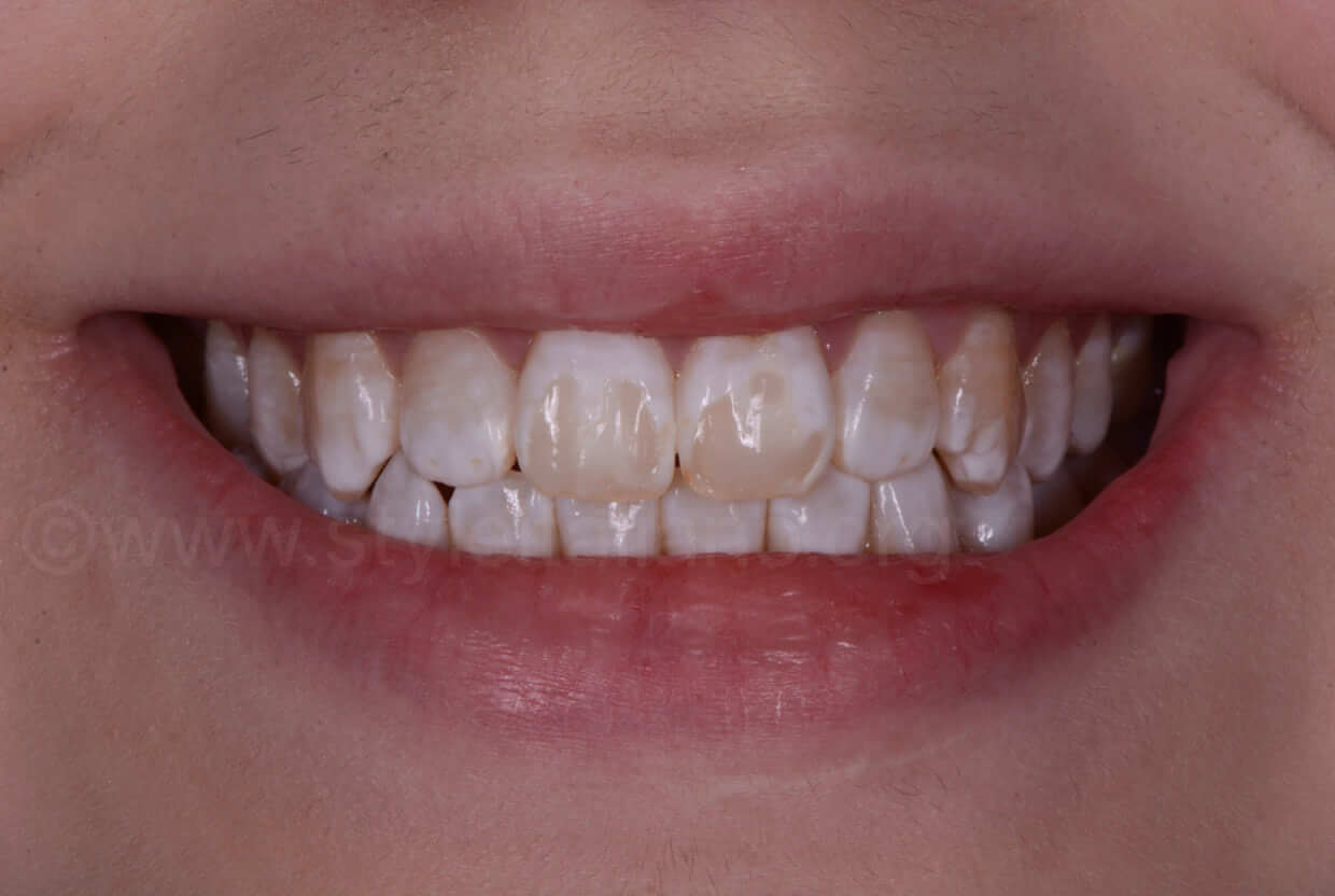 FLUOROSE DENTAL