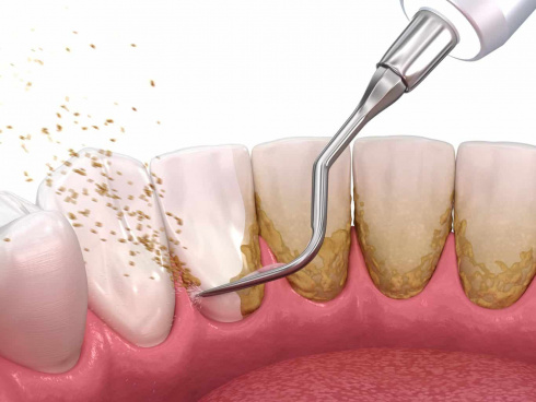 Diferenças - Limpeza e Raspagem Dentárias